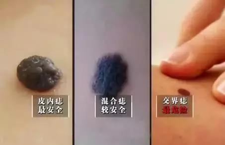 每个人都一定有痣吗,每一个痣都是代表疾病吗