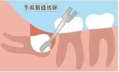 拔完智齿多久可以刷牙洞,拔完智齿的洞多久能长好
