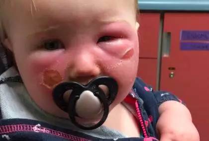 宝宝烧伤应该抹什么药膏,宝宝烧伤结痂应该抹什么药膏