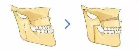 儿童口腔科正畸多大可以做,口腔戴牙套需要无菌操作么