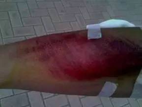 运动防护和急救小知识,运动伤害防护与急救知识点