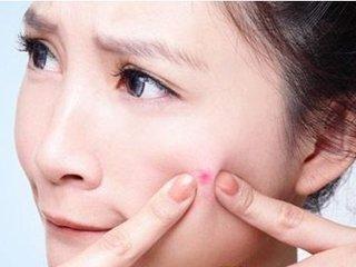 严重粉刺的最佳治疗方法,粉刺怎么治疗最有效的方法