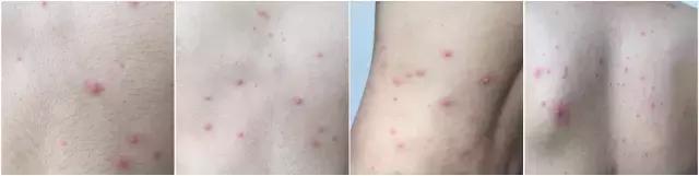 为什么说水痘不要吹风,小孩长水痘为什么不能吹风