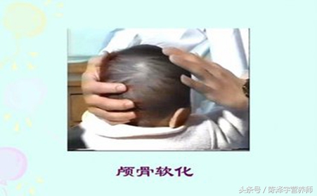 孩子25羟基维生素d严重缺乏表现,25羟基维生素d严重缺乏吃什么药