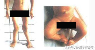 孩子25羟基维生素d严重缺乏表现,25羟基维生素d严重缺乏吃什么药