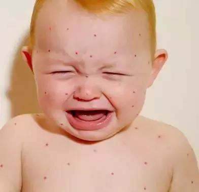 为什么说水痘不要吹风,小孩长水痘为什么不能吹风