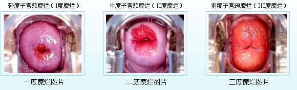 查出宫颈癌前病变，离宫颈癌还有多远