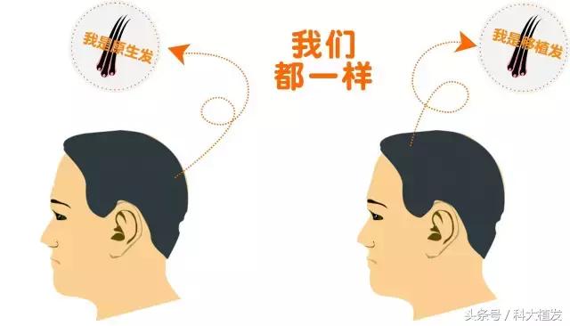 移植的头发与原生头发有区别吗,移植的头发是继续生长还是脱落
