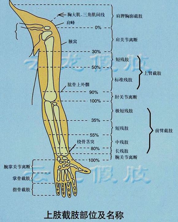 截肢后戴假肢老是疼怎么处理,截肢病人注意事项