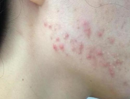 下巴反复长痘痘的原因和解决方法,下巴长期长痘痘的原因和解决方法