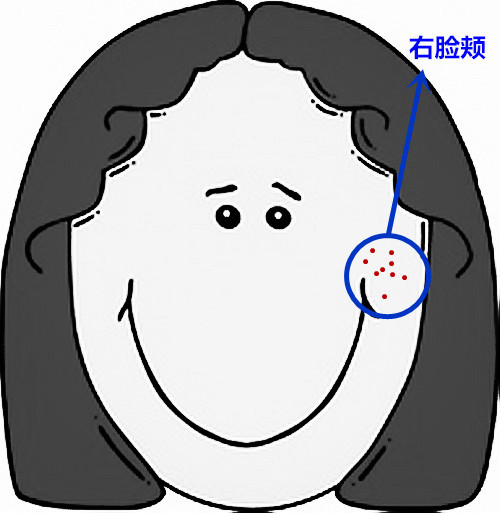 脸部痘痘看身体状况,超全面面部痘痘分析图文