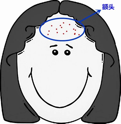 脸部痘痘看身体状况,超全面面部痘痘分析图文