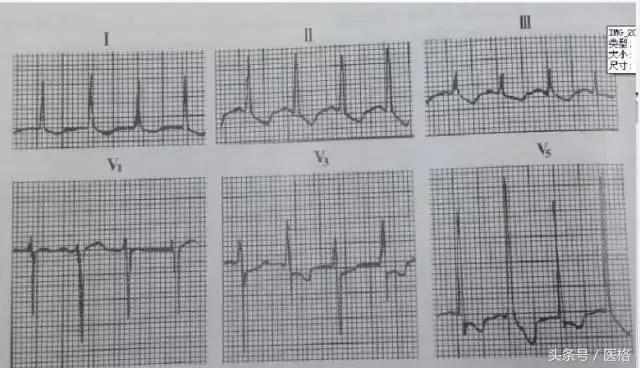 电交替,电交替现象临床意义