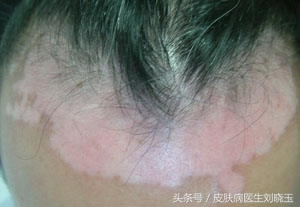 专家剖析白癜风的病因,白癜风患者查明病因的重要性