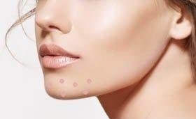 下巴反复长痘痘的原因和解决方法,下巴长期长痘痘的原因和解决方法