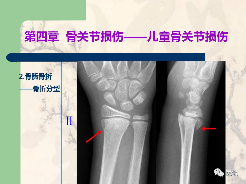 骨关节创伤x线诊断图谱,骨关节损伤x线图