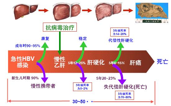 肝硬化肝癌诊治病例分享,2023年肝病防治指南