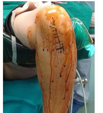 膝盖疼半月板损伤用什么药,老人膝盖半月板损伤怎么办