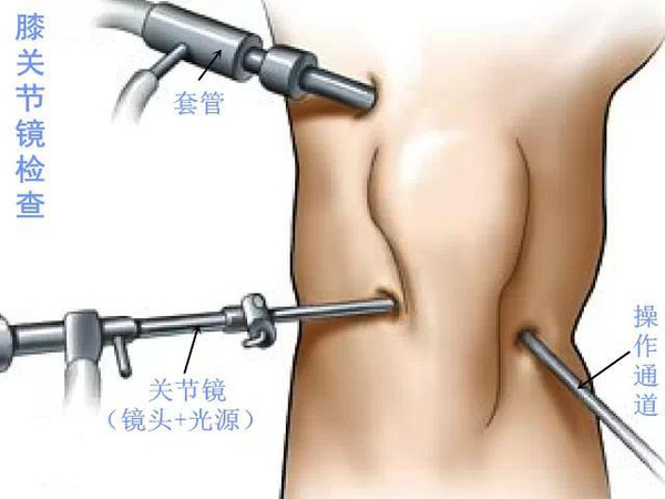 膝盖疼半月板损伤用什么药,老人膝盖半月板损伤怎么办