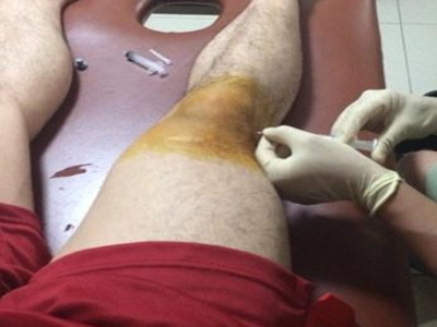 膝盖疼半月板损伤用什么药,老人膝盖半月板损伤怎么办