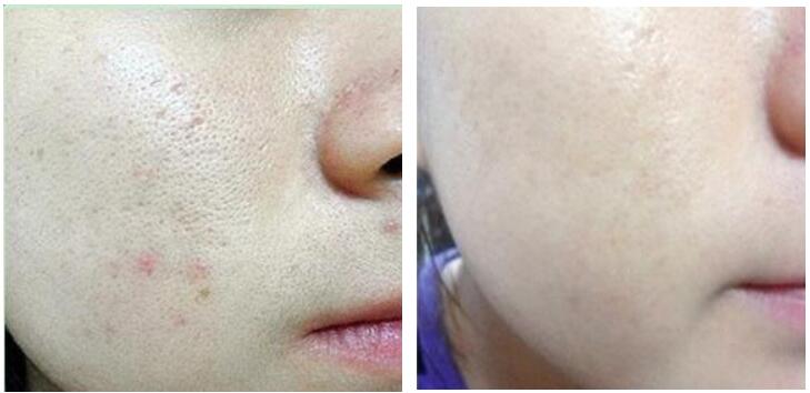 点阵激光可以解决皮肤老化吗,激光点阵和射频