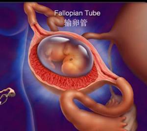 异位妊娠保守治疗护理诊断,异位妊娠保守治疗成功