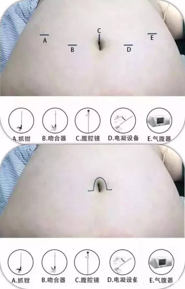 腹腔镜手术用缝合吗,腹腔镜手术的利弊