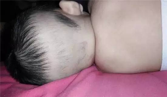 枕秃到底是缺钙还是正常,枕秃缺钙