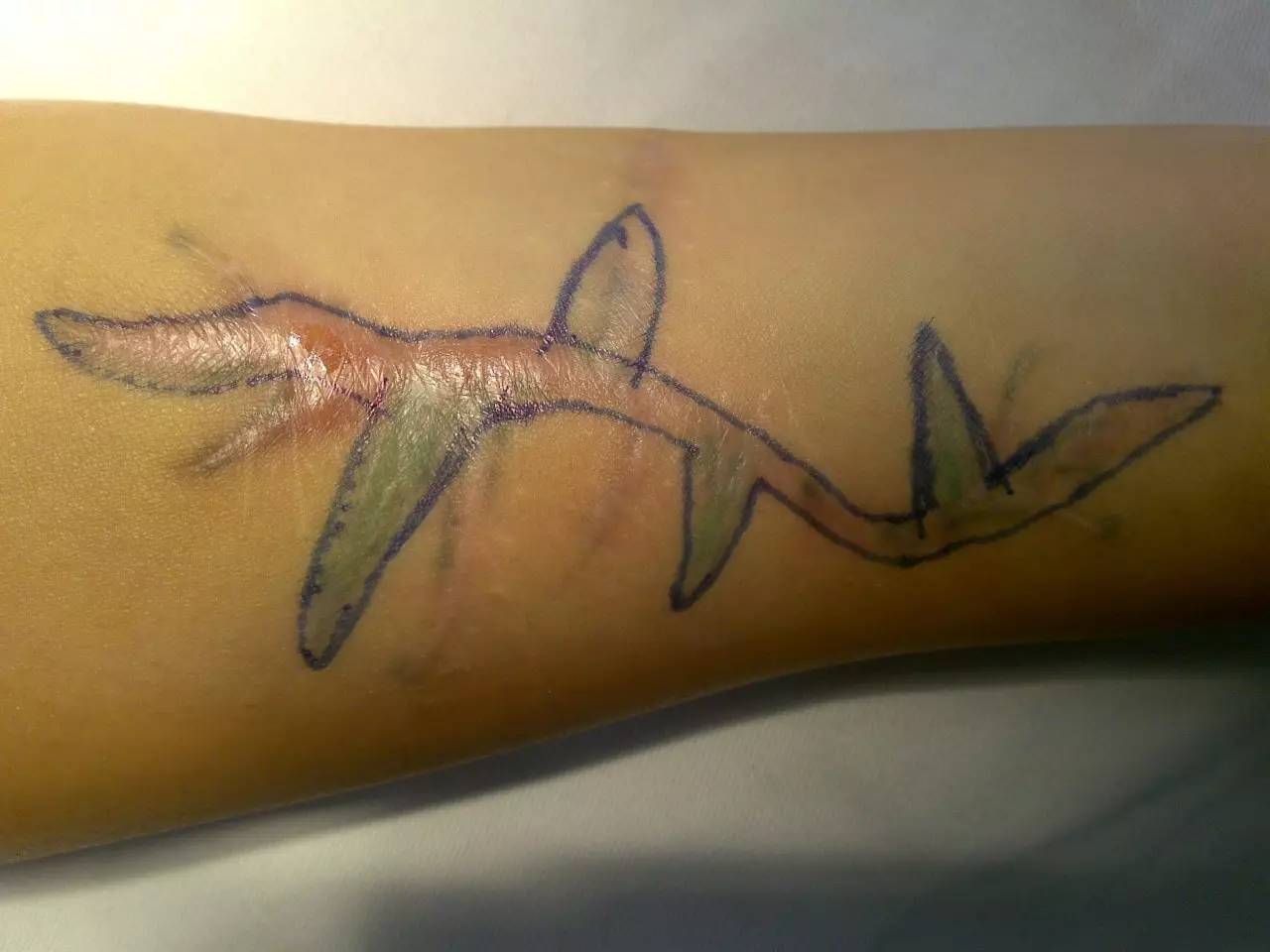 30年的手术疤痕,28年的手术疤痕