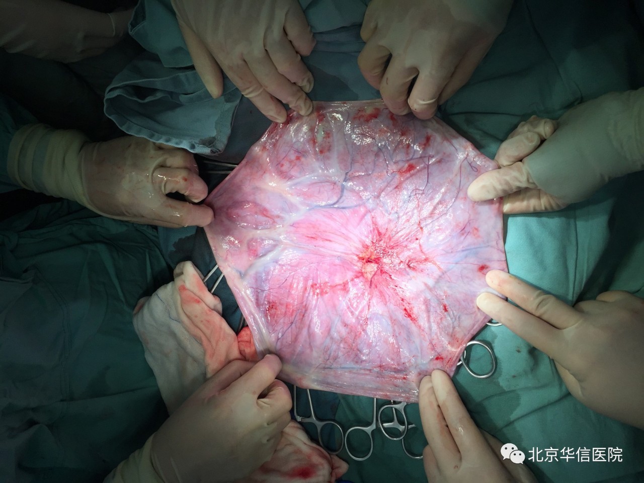 附件囊肿大于5cm一定要手术吗,附件囊肿手术是全麻还是局部麻醉