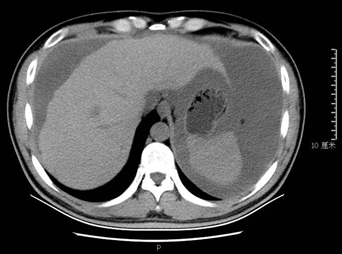 腹胀是怎么回事小心是这里生病了,腹胀是什么原因引起的胃不舒服