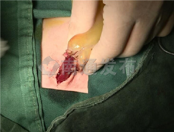 胎儿肠外露,胎儿膈疝需要开刀吗