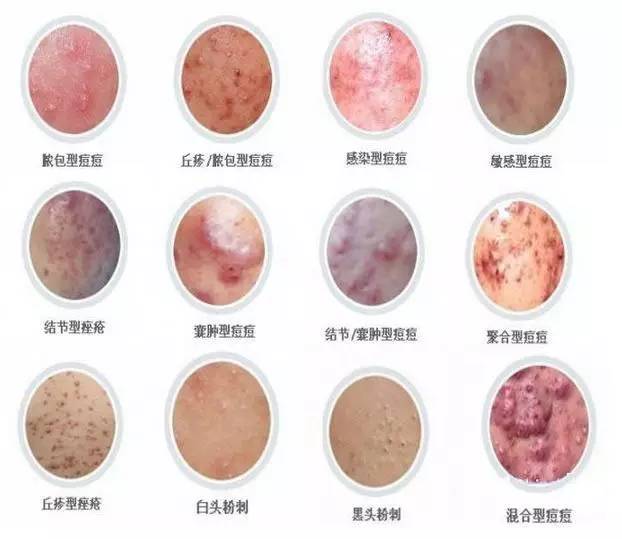 乌鲁木齐祛痘痘最好的地方,乌鲁木齐专业消除痘痘