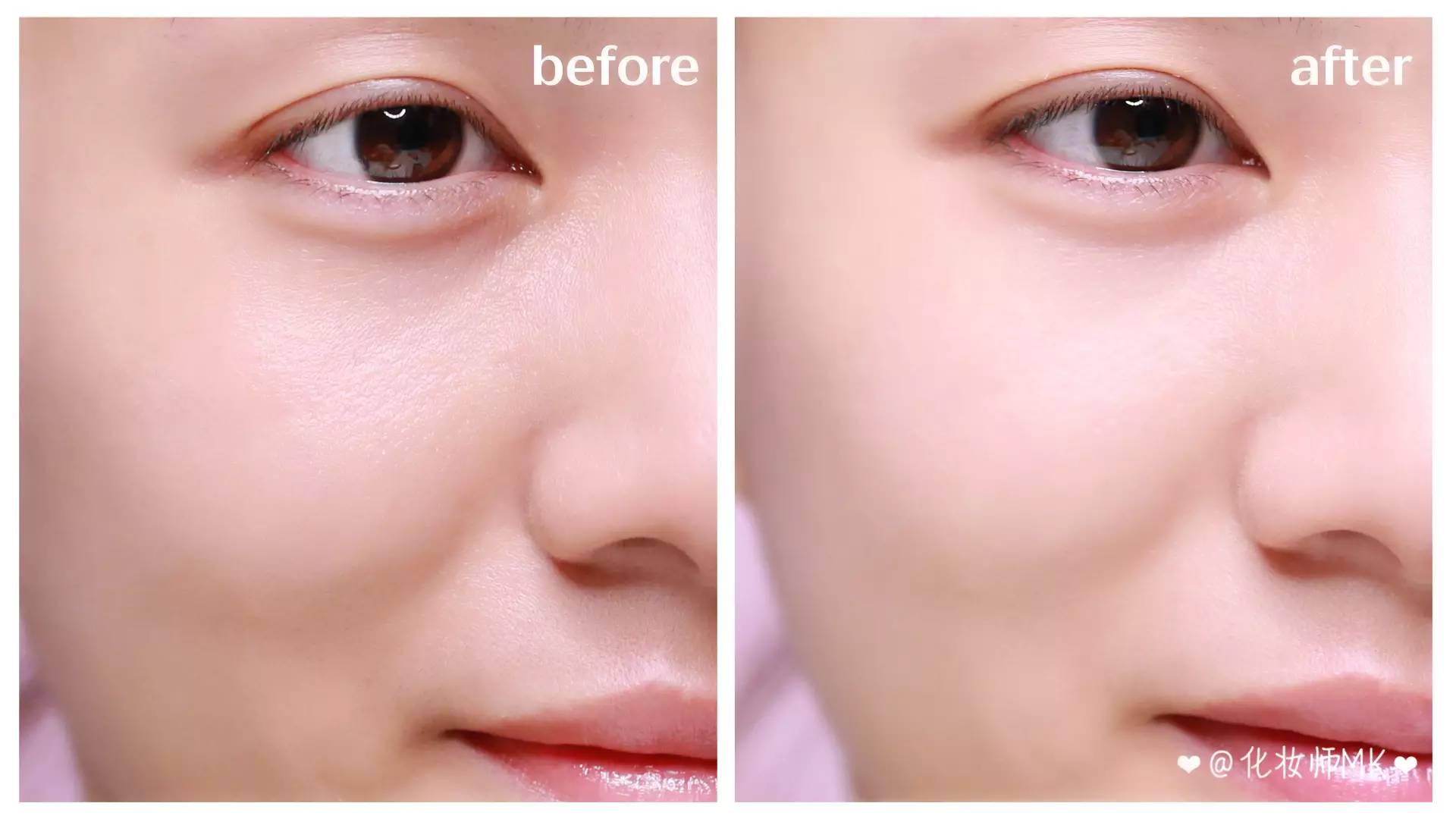 有没有去除脸部皱纹的小神器,改善脸部细纹推荐