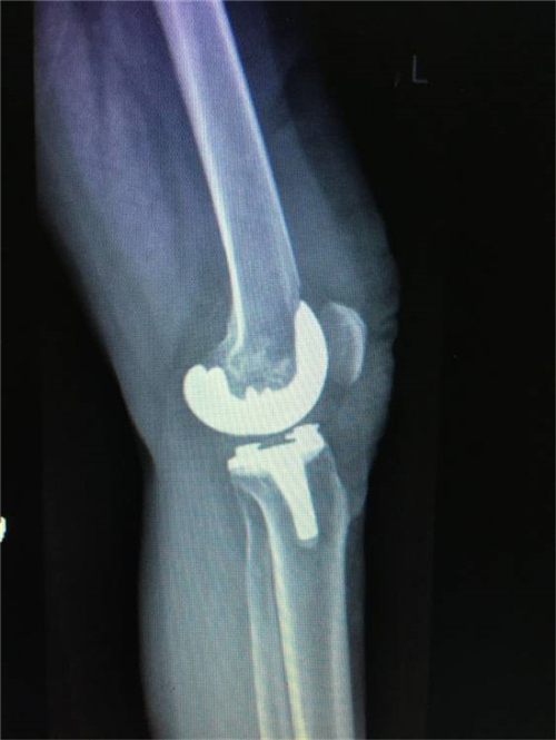 湘雅医院膝关节置换手术案例,赣州膝关节置换手术