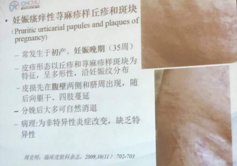 幼儿麻疹的鉴别方法,儿童麻疹的诊断与治疗