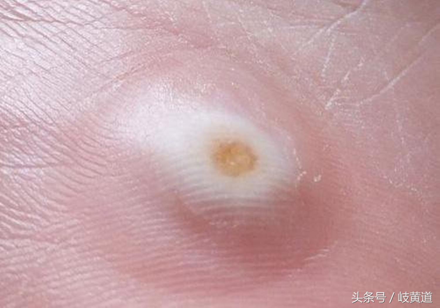 人脚上的鸡眼怎么治除根,很多鸡眼怎么去除