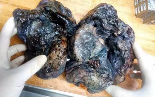 吸烟的十大伤害十大疾病,吸烟在中医上的作用与功效有哪些