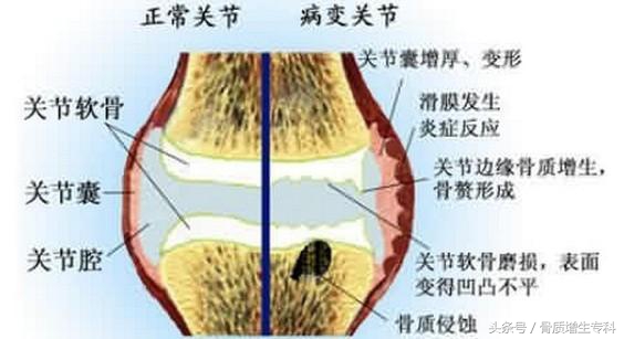 膝关节骨质增生如何锻炼恢复,膝关节骨质增生最好的锻炼方法