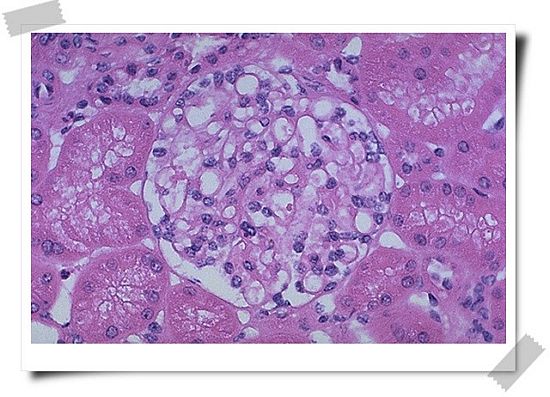 肾病患者吃了激素跟没吃一样，这是怎么回事？