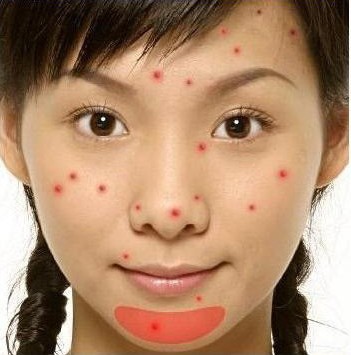 针对长在不同部位的痘痘，教你祛痘秘诀，还你18岁美丽肌肤！