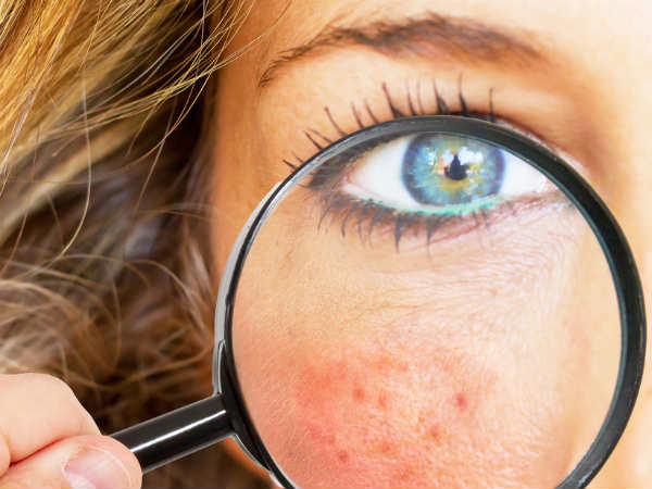 脸上很多痘痘禁忌什么食物,脸上有痘痘忌口的食物是哪些