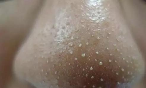 鼻子脸部挤出白色线状米粒是什么,鼻子上挤出的白色条状物到底是啥