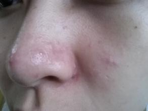 鼻子脸部挤出白色线状米粒是什么,鼻子上挤出的白色条状物到底是啥