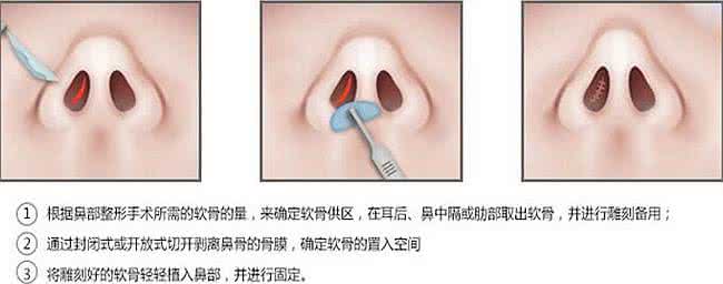 郑州隆鼻价格一览表,隆鼻需要多少钱