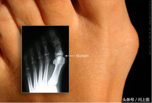 常见脚病图解最新版,各种脚病的科普视频