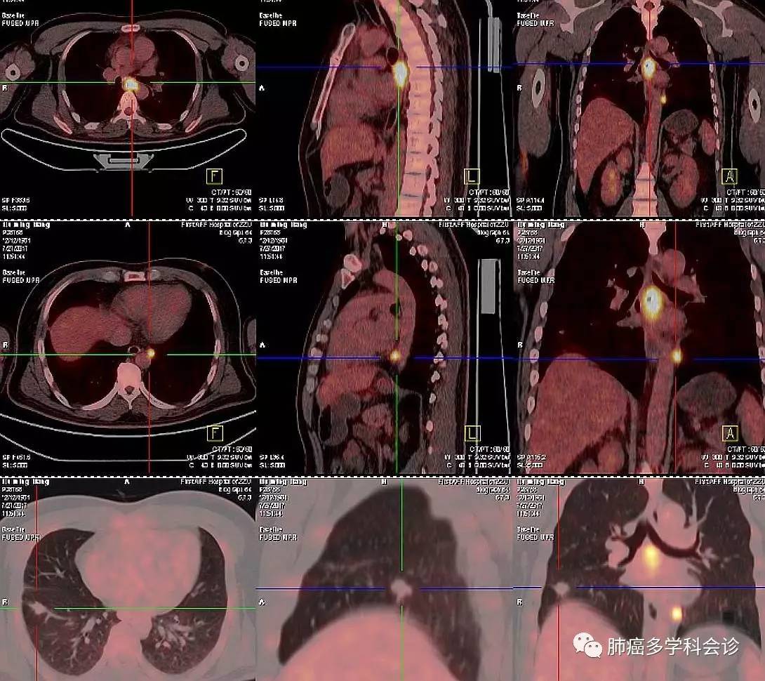 食管癌转移两侧淋巴癌严重吗,食管癌转移和扩散区别