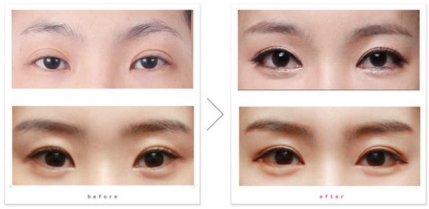 娱乐圈不老男神的秘诀,明星们的冻龄秘诀玻尿酸