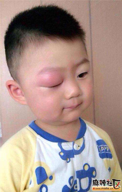 驱蚊液成分怎么选,驱蚊液注意事项避免儿童接触