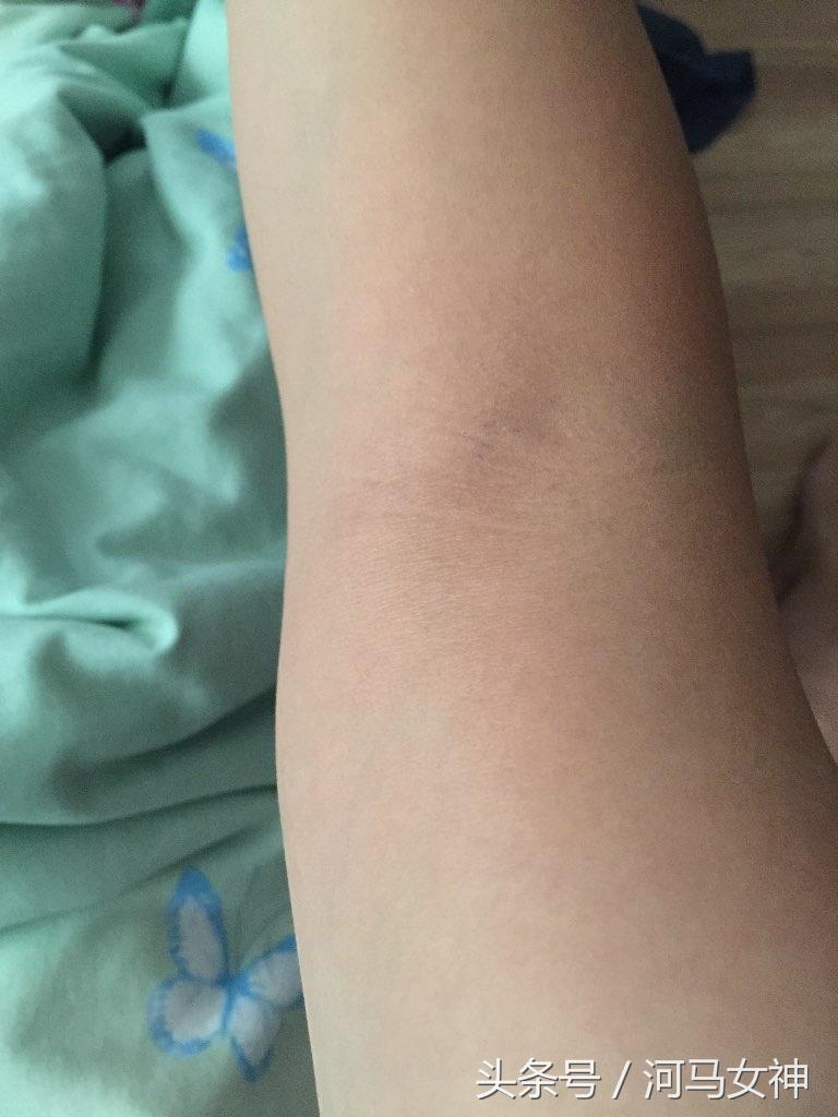 药物过敏反应抢救指南,药物过敏反应病程记录